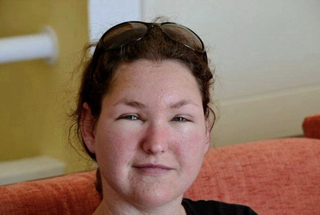 отечное лицо женщины